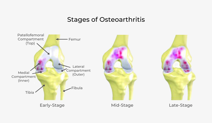 This is a graphic of a knee joint depicting the stages of osteoarthritis.